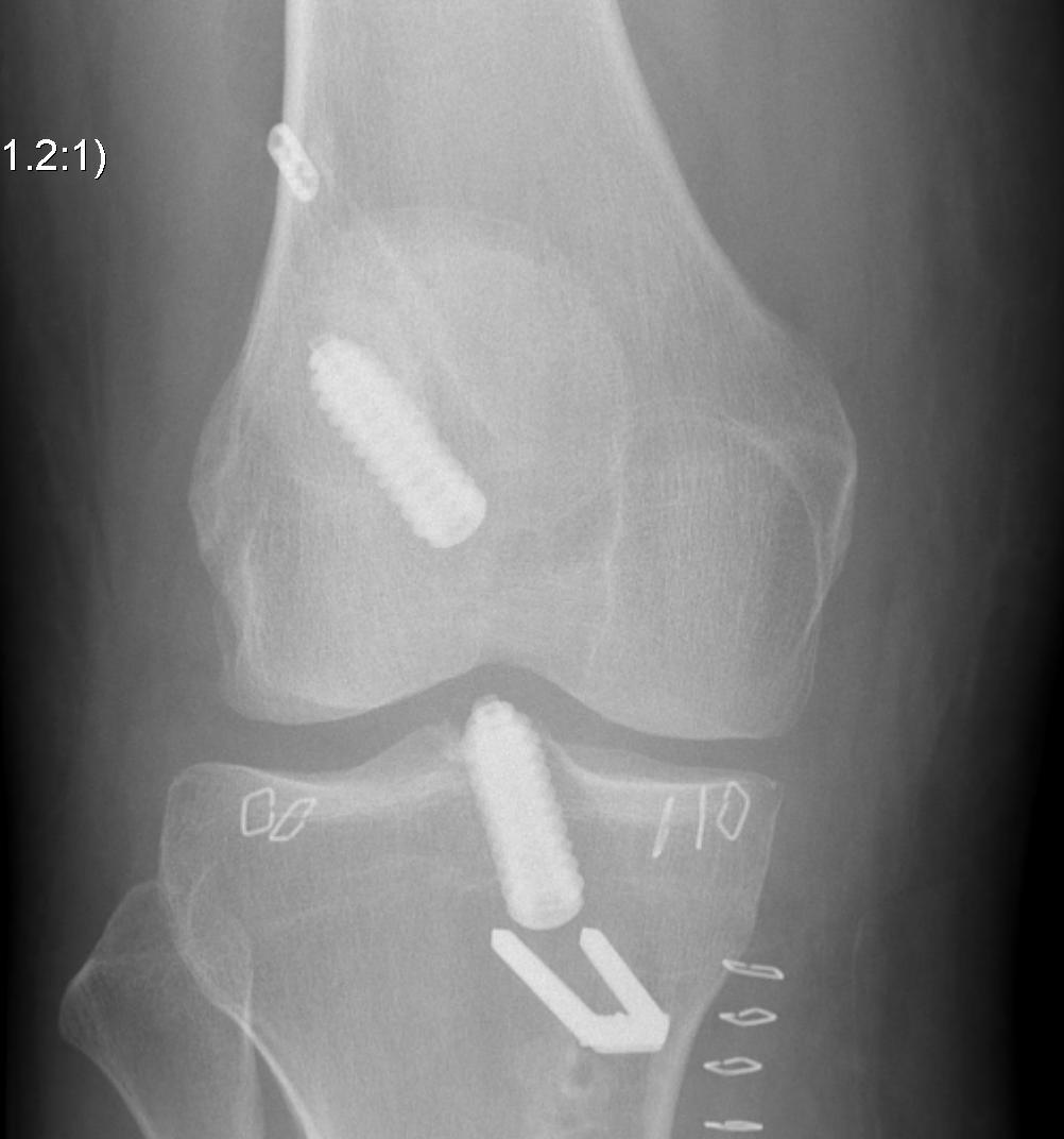 Revision ACL Post op AP